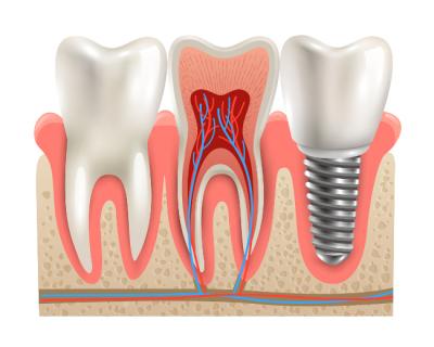 implant dentaire creil
